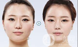 做過顴骨和下顎角手術(shù)后的感受