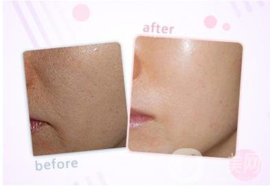 上海玻尿酸豐面頰價(jià)格是多少錢