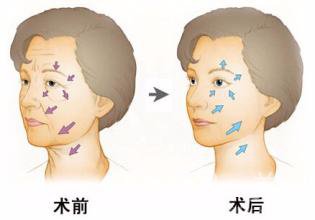 上海玻尿酸豐面頰價(jià)格是多少錢