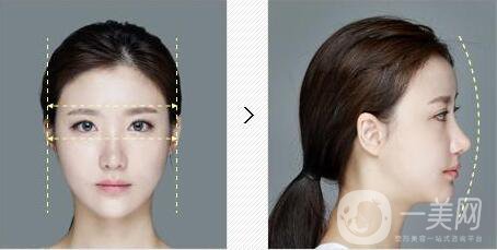 降低顴骨,降低顴骨方法,降低顴骨術(shù)后護理