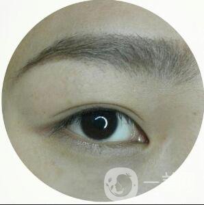 割雙眼皮手術(shù)術(shù)后疼幾天能恢復(fù)好