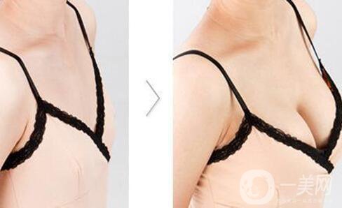 假體隆胸后感覺(jué)好嗎