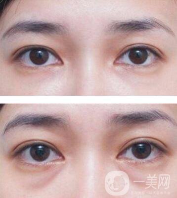 廣東自體脂肪填充淚溝多少錢？