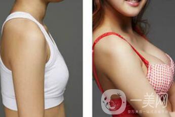 上海假體隆胸的價(jià)格高嗎？要多少錢