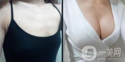 上海假體隆胸的價(jià)格高嗎？要多少錢