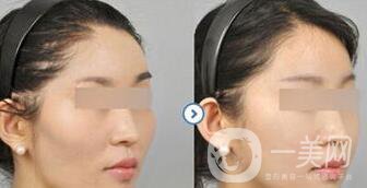 磨顴骨多久能恢復(fù) 磨顴骨價格多少