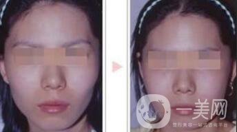 磨顴骨多久能恢復(fù) 磨顴骨價格多少