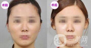 磨顴骨多久能恢復(fù) 磨顴骨價格多少