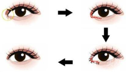 開(kāi)眼角手術(shù)價(jià)格 價(jià)格影響因素分析