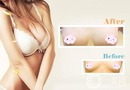 假體豐胸,假體豐胸術(shù)后護理