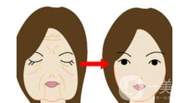 電波拉皮步驟,電波拉皮*果