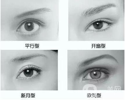 割雙眼皮,割雙眼皮維持多久,割雙眼皮多久恢復