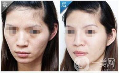 自體脂肪墊下巴術(shù)后護理注意事項有哪些