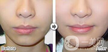 自體脂肪墊下巴術(shù)后護理注意事項有哪些