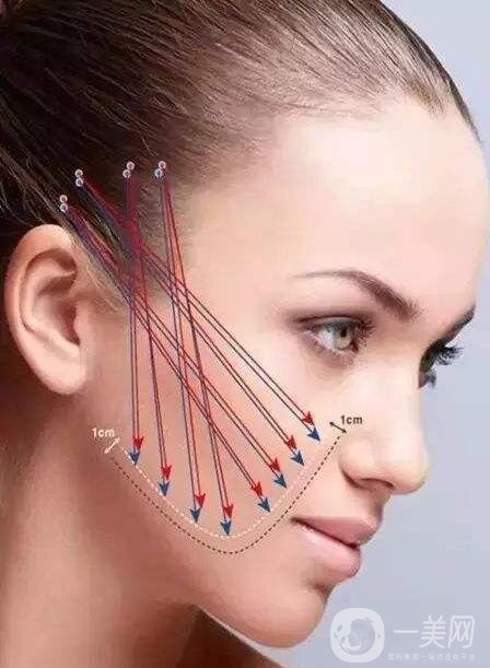 面部拉皮,面部拉皮多少錢,深圳面部拉皮多少錢