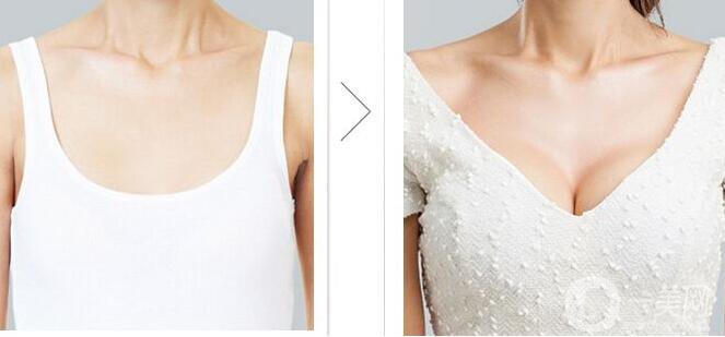 北京隆胸多少錢,隆胸注意事項(xiàng)