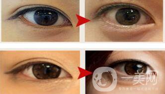 玻尿酸豐臥蠶術后護理怎么做