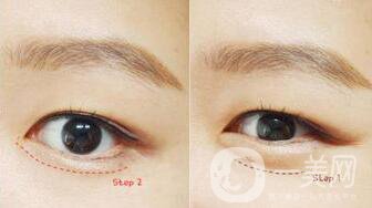 玻尿酸豐臥蠶術后護理怎么做