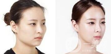 磨顴骨注意事項(xiàng)具體有哪些