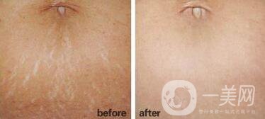 廣東激光去妊娠紋大概多少錢