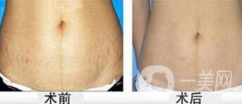 上海消除妊娠紋多少錢