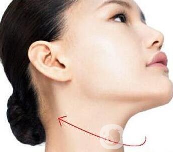 雙下巴吸脂術后護理方法