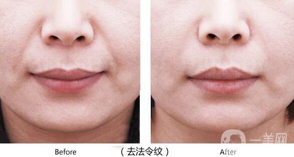 *去法令紋術(shù)后護(hù)理要怎么做