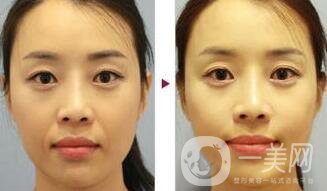 *去法令紋術(shù)后護(hù)理要怎么做