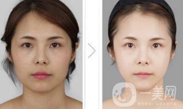 光纖溶脂好不好？價格是多少