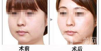 光纖溶脂好不好？價格是多少