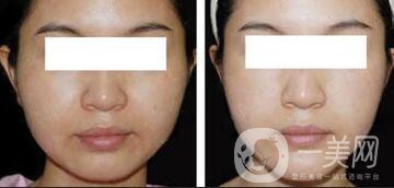 光纖溶脂好不好？價格是多少