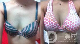 成都假體豐胸多少錢