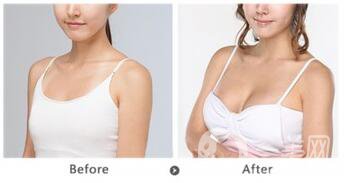 隆胸的危害有哪些 如何避免隆胸失敗