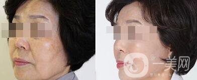 廈門做拉皮手術多少錢