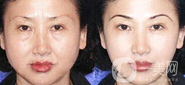 廈門做拉皮手術多少錢