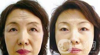 廈門做拉皮手術多少錢