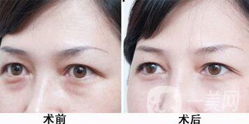 北京溶脂去眼袋價格是多少