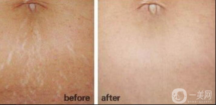 激光去妊娠紋多少錢(qián),激光去妊娠紋術(shù)后護(hù)理