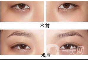 割雙眼皮埋線過程圖,埋線雙眼皮注意事項(xiàng)