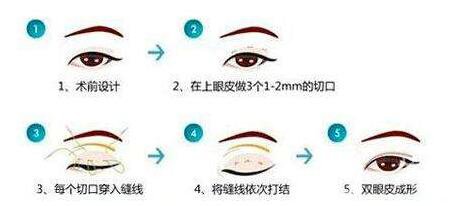 割雙眼皮埋線過程圖,埋線雙眼皮注意事項(xiàng)