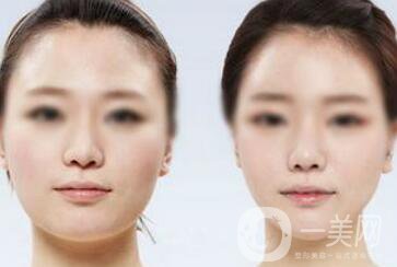 面部光纖溶脂好嗎？價格是多少