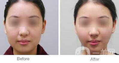 面部光纖溶脂好嗎？價格是多少