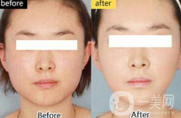 面部光纖溶脂好嗎？價格是多少