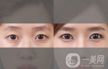 北京現(xiàn)在割雙眼皮多少錢