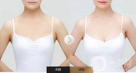 隆胸后怎么護(hù)理？術(shù)前怎么準(zhǔn)備？