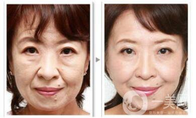 汕頭電波拉皮除皺多少錢