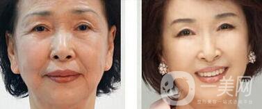 汕頭電波拉皮除皺多少錢