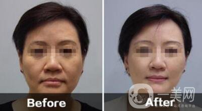 汕頭電波拉皮除皺多少錢