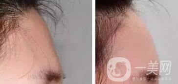 廣東自體脂肪填充額頭多少錢