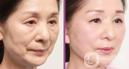 拉皮除皺能堅(jiān)持幾年？與哪些因素有關(guān)？